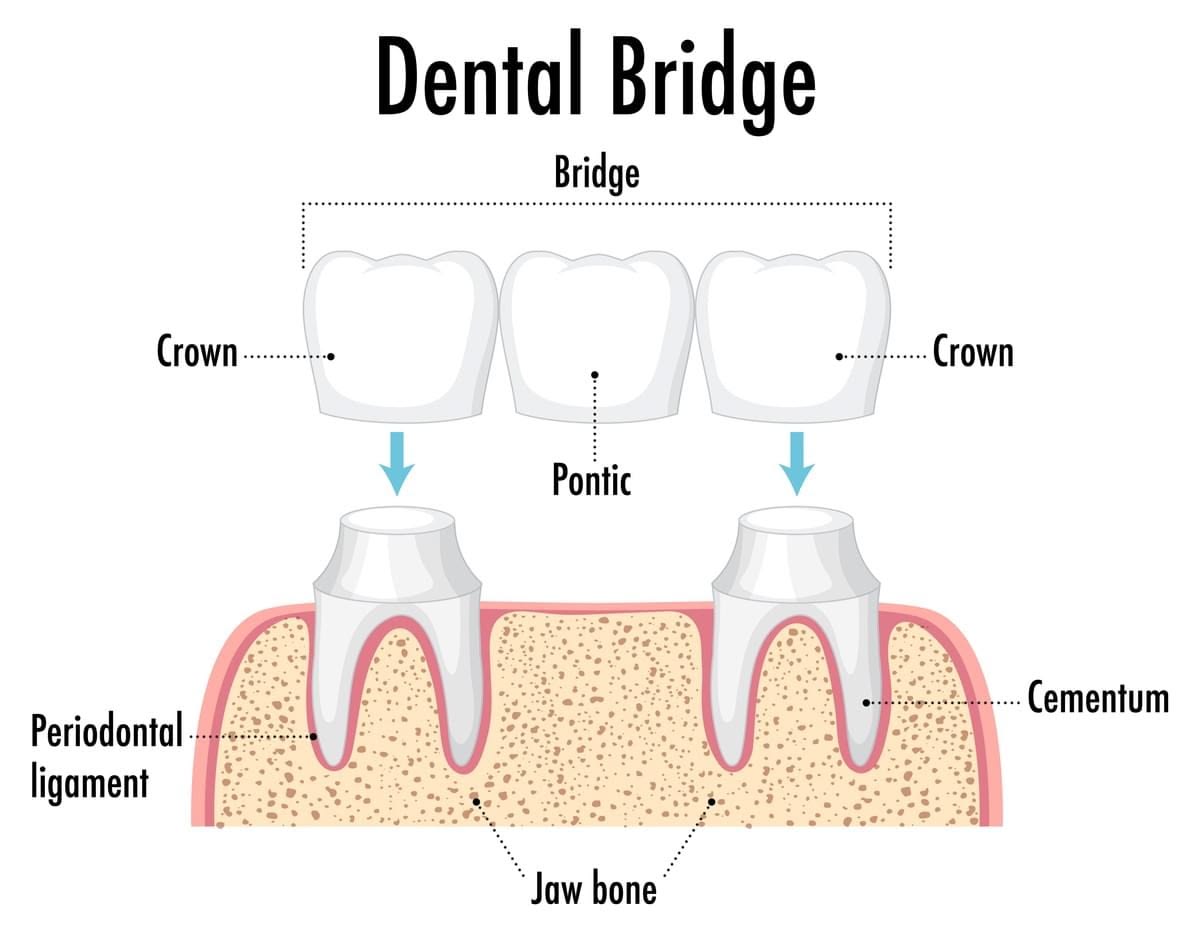Crowns and bridges diagram illustrating pontic placement between abutment crowns at Oakville Dental