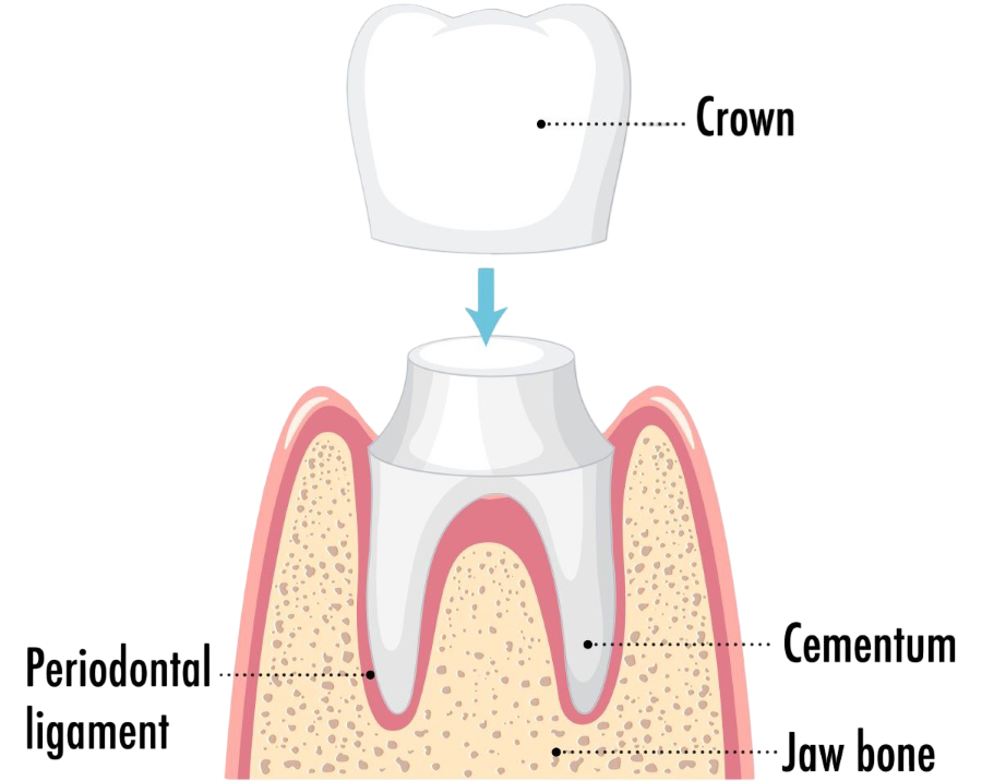Same-Day Crown Procedure Oakville | Crown Placement Over Prepared Tooth Same-day crown procedure in Oakville – anatomical diagram showing a porcelain crown being placed over a prepared tooth at Oakville Dental
