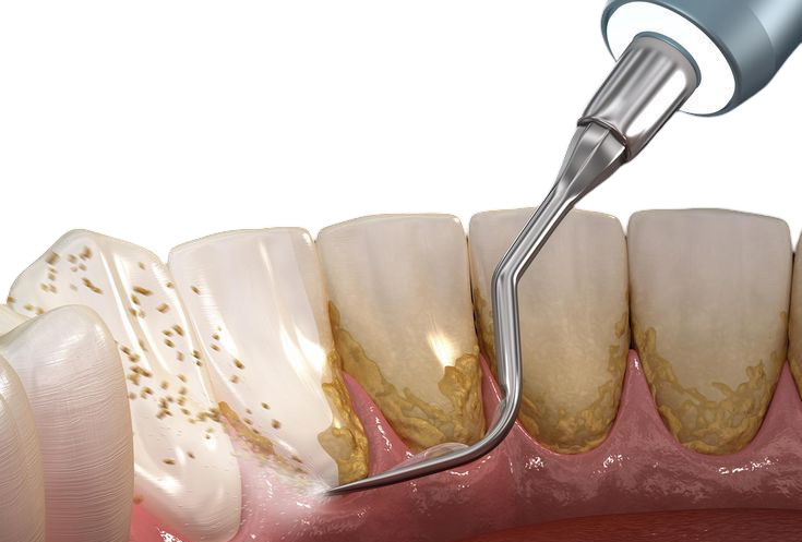 Scaling and Root Planing Procedure – Tartar Removal Below the Gumline at Oakville Dental Scaling and root planing instrument removing tartar buildup below the gumline during a deep cleaning procedure