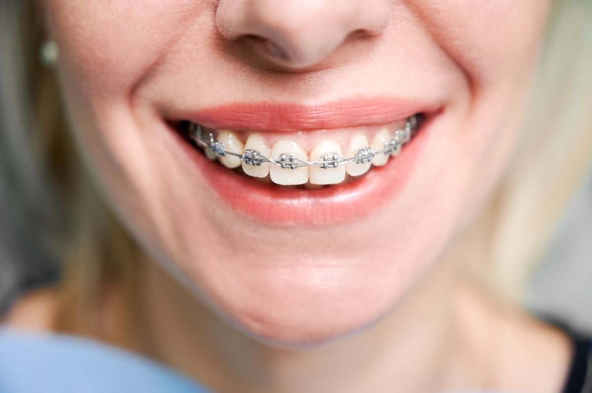 Traditional Braces